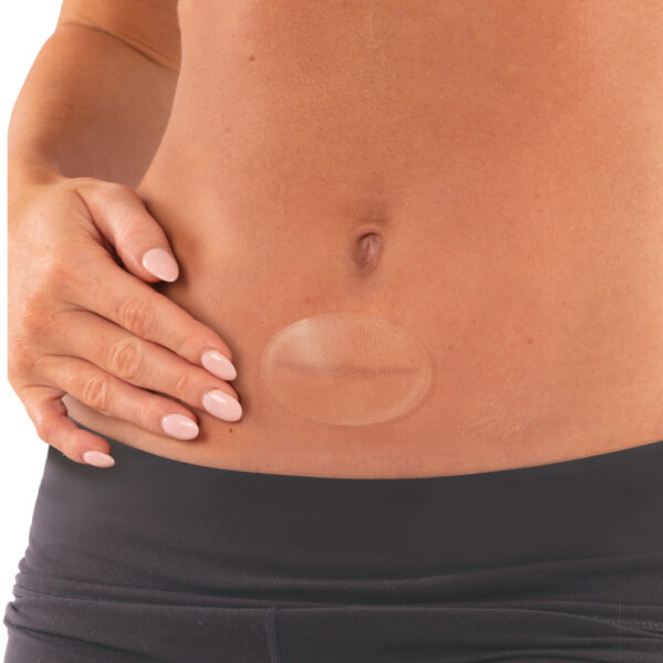 AEROSCAR Silicone Scar Patch 7.4 x 4.4cm Box/10 - Image 3