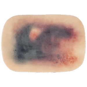 TraumaSim Self-Adhesive Large Haematoma