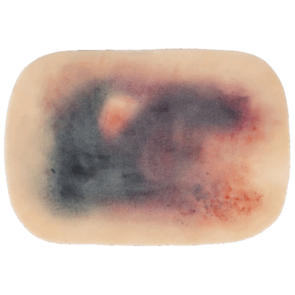 TraumaSim Self-Adhesive Large Haematoma